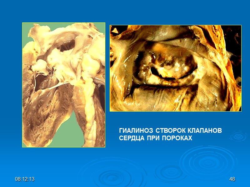 ГИАЛИНОЗ СТВОРОК КЛАПАНОВ  СЕРДЦА ПРИ ПОРОКАХ 08:12:01 48